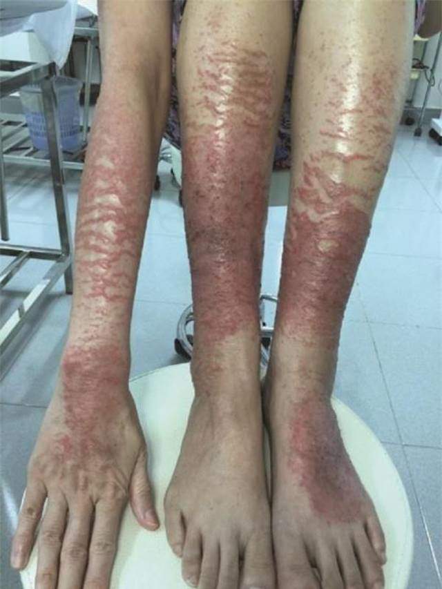 Đi tắm trắng, c&ocirc; g&aacute;i khiến cả mạng x&atilde; hội hốt hoảng v&igrave; da ...