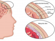 Sức khỏe - Bé trai bị hôn mê vì căn bệnh nguy hiểm mà cứ ngỡ sốt đau đầu thông thường