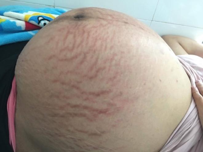 Mẹ Hưng Yên mang thai 4, sinh 3 khiến các bác sĩ trầm trồ vì 1000 ca mới có một - 3