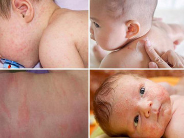Trẻ bị rôm sảy cần chữa thế nào?
