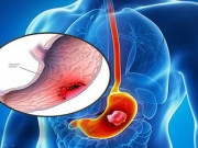 Sức khỏe - Thiếu nữ 18 tuổi đau bụng nhẹ đi khám phát hiện ung thư dạ dày giai đoạn cuối