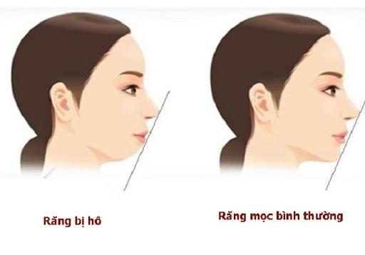 Ngỡ ngàng trước sự lột xác vi diệu nhờ niềng răng, dung mạo thay đổi 180 độ - 1