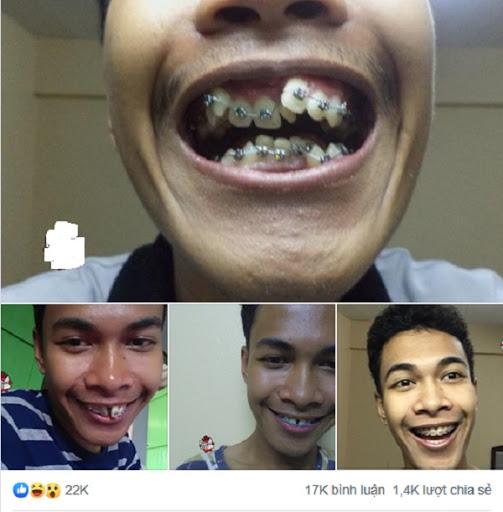 Ngỡ ngàng trước sự lột xác vi diệu nhờ niềng răng, dung mạo thay đổi 180 độ - 2