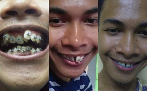 Ngỡ ngàng trước sự lột xác vi diệu nhờ niềng răng, dung mạo thay đổi 180 độ - 3