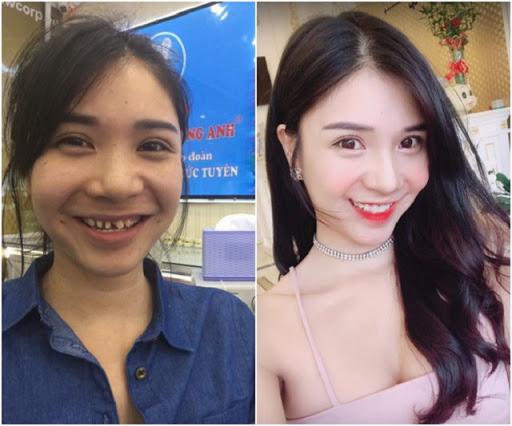 Ngỡ ngàng trước sự lột xác vi diệu nhờ niềng răng, dung mạo thay đổi 180 độ - 8