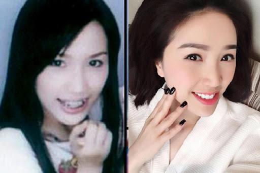Ngỡ ngàng trước sự lột xác vi diệu nhờ niềng răng, dung mạo thay đổi 180 độ - 9
