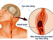 Sức khỏe - Chàng trai 23 tuổi bất ngờ phải nhập viện vì căn bệnh thường gặp ở người già