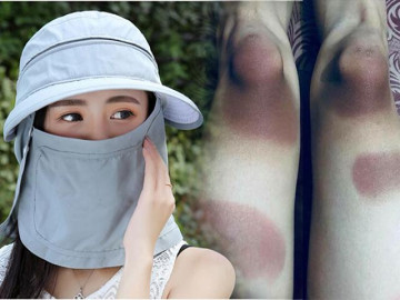 Cái kết méo mặt khi đi giữa trời nắng mà không che chắn kỹ cho làn da là đây