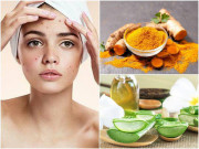 Làm đẹp - 15 Cách trị mụn bọc sưng đỏ tại nhà bằng phương pháp tự nhiên hiệu quả