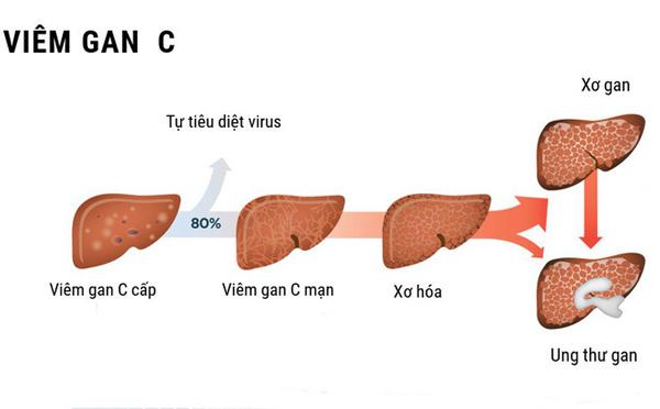 viem gan c: trieu chung, nguyen nhan va duong lay lan - 2