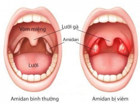 Viêm amidan cấp ở trẻ: Nguyên nhân, triệu chứng và cách điều trị