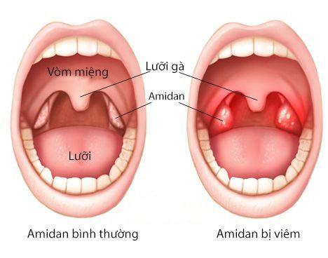 viem amidan cap o tre: nguyen nhan, trieu chung va cach dieu tri - 1