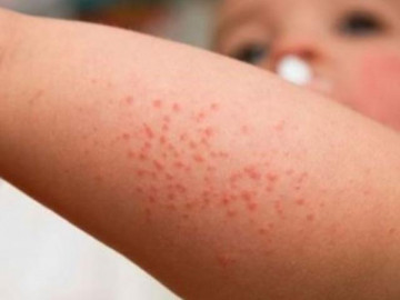 Trẻ bị sởi: Nguyên nhân và những dấu hiệu cha mẹ cần biết