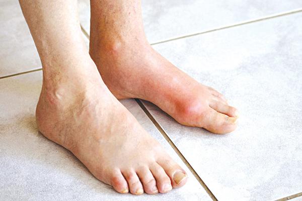 benh gout: trieu chung, dieu tri va cach an uong han che benh - 1