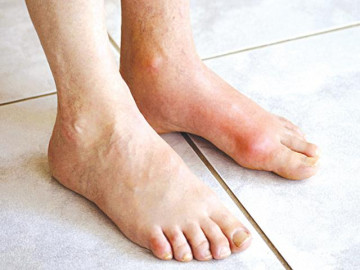 Bệnh Gout: Triệu chứng, điều trị và cách ăn uống hạn chế bệnh