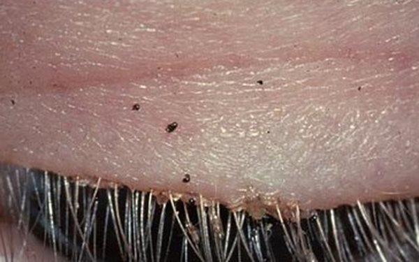 4 Cách trị bọ rệp những ngày mưa ẩm an toàn mà hiệu quả