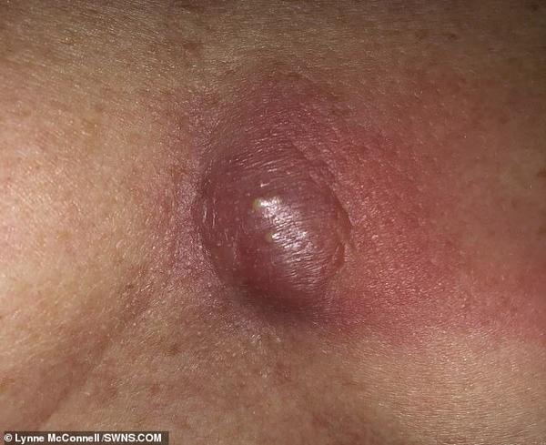 mac ao lot gong nang "vong mot", nguoi phu nu bi thung mot lo ngay giua nguc - 2