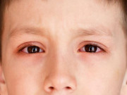 Làm mẹ - Đau mắt đỏ ở trẻ được chuẩn đoán qua những dấu hiệu triệu chứng nào?