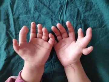 Hy hữu: Bé gái sinh ra với 14 ngón tay và ca phẫu thuật đổi đời