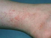 Sức khỏe - Cô gái 28 tuổi suýt mất mạng vì tưởng mẩn đỏ ở chân là dị ứng nhưng sự thật là...