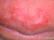 Sức khỏe - Nữ sinh nhiễm virus gây bệnh tình dục dù chưa quan hệ vì một sai lầm khi dùng mỹ phẩm