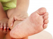 Sức khỏe - 5 việc cha mẹ bắt buộc phải làm khi trẻ bị tay chân miệng để tránh biến chứng nguy hiểm