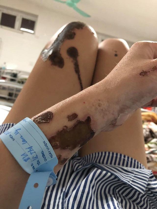 co gai xinh dep bi chong sap cuoi la cong an tat axit: dau don khi nhin lai anh cu - 2