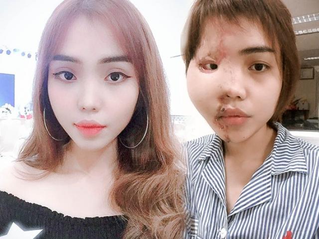 Đâu là sự thật đằng sau câu chuyện cô gái quê Đà Nẵng bị hôn phu tạt axit?