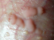 Sức khỏe - Con gái 1 tuổi bị sùi mào gà, nguyên nhân đến từ chiếc quần mẹ hay cho con mặc