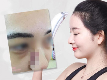 "Tự xử" mụn cứng đầu với máy hút mụn cầm tay, cô gái nhận cái kết... đắng lòng!