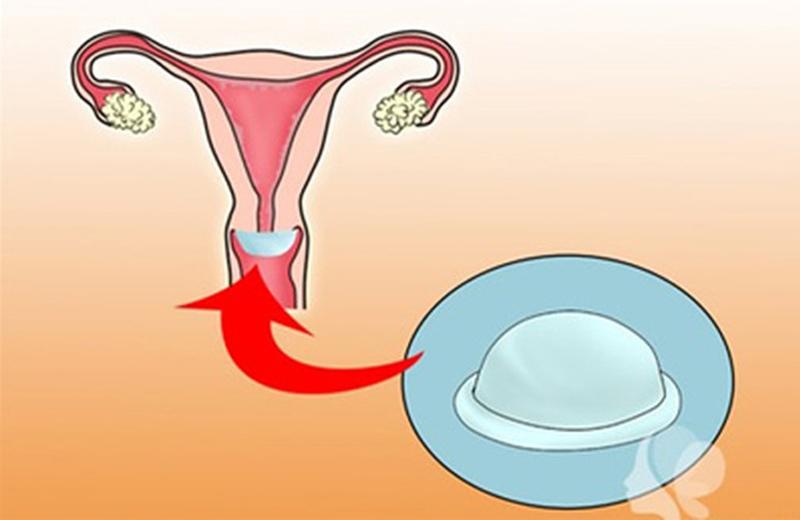 Ưu điểm là kiểm soát được mong muốn mang thai như khi sử dụng bao cao su nam. Có thể được sử dụng đối với cả phụ nữ sau sinh 6 tuần mà không gây tác dụng hoặc phản ứng phụ.
