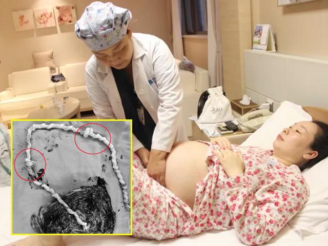 Mổ đẻ cho mẹ bầu 35 tuần, bác sĩ choáng váng khi nhìn dây rốn 20 năm chưa từng gặp