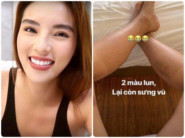 Kỳ Duyên khiến fan hốt hoảng vì da cháy nắng, loang lổ vết bầm tím sau thời gian mất tích