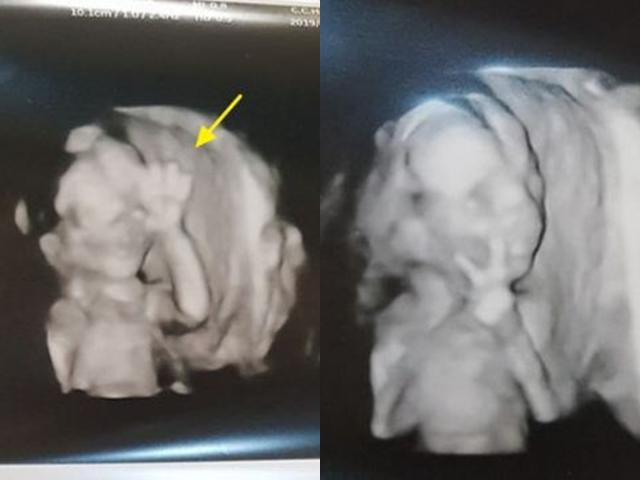 Đi siêu âm con trong bụng, hình ảnh em bé khiến bố mẹ không tin nổi vì quá đặc biệt