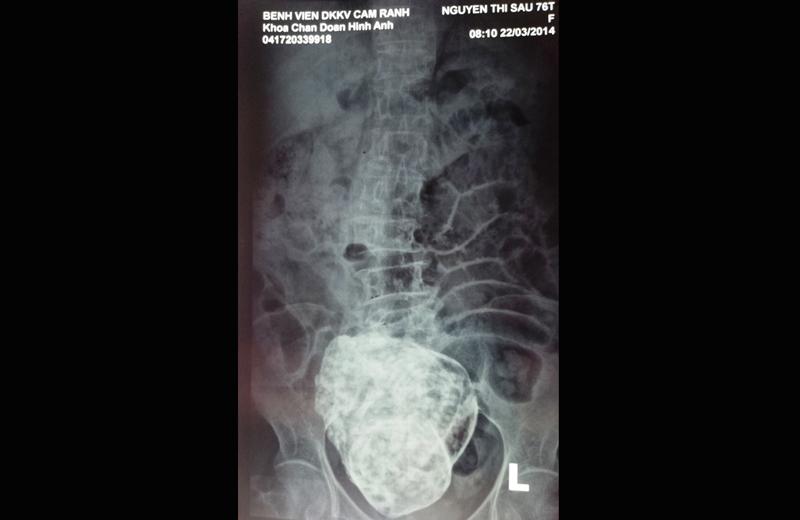Mãi đến năm 2014, khi thấy cơ thể liên tục bị đau nhức, đau cột sống, thắt lưng và vùng hạ vị dữ dội, bà Sáu được đưa vào viện khám và chụp X-quang thì bác sĩ mới phát hiện thai nhi đã vôi hóa trong tử cung. 
