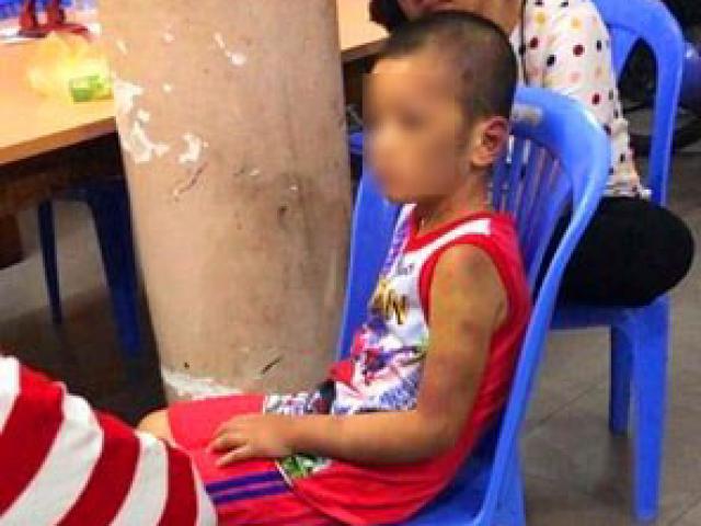 Mẹ và bạn tình đồng tính bạo hành con: Bé bị tra tấn hằng ngày bằng tay chân, cán chổi
