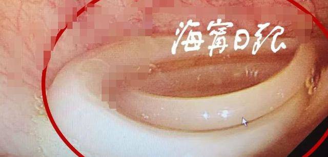 Đau bụng hơn 10 năm, người phụ nữ không ngờ thứ này tồn tại trong cơ thể - 3