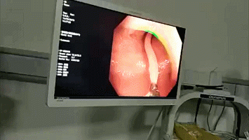 Đau bụng hơn 10 năm, người phụ nữ không ngờ thứ này tồn tại trong cơ thể - 1