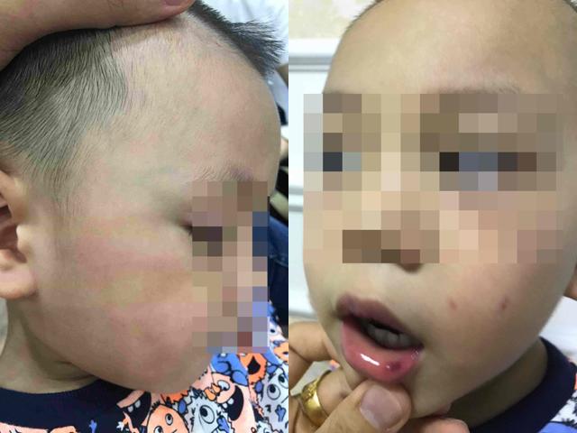 Mẹ phát hiện con 3 tuổi bị cô giáo đánh bầm dập, tụ máu mồm chỉ vì lý do này