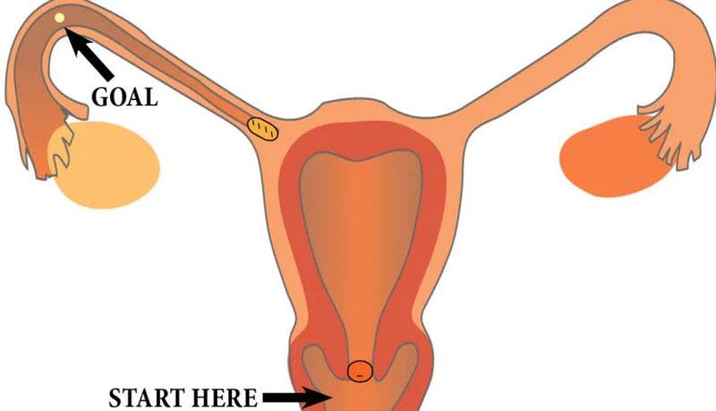 Trường hợp tinh trùng đã thành công xâm nhập vào cơ thể phụ nữ. Nó sẽ phải đi một quãng đường dài trong tử cung.
