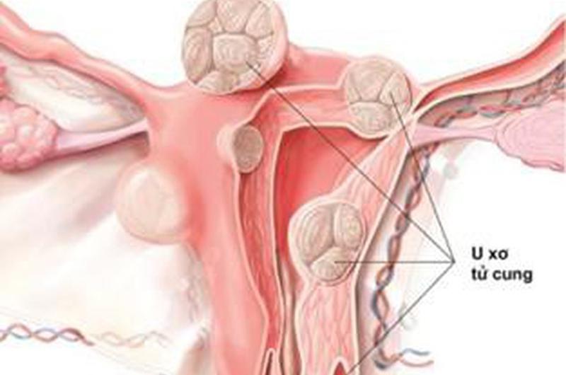 U xơ tử cung, giống như tăng sản vú của phụ nữ, là một loại mô phát triển trong tử cung. Khi nó xảy ra, nó có thể gây ra sự khởi phát của viêm cổ tử cung, dẫn đến tiết dịch âm đạo bất thường. 

