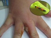 Sức khỏe - Độc kiến ba khoang mạnh gấp 15 lần nọc độc rắn, học ngay 4 bước sơ cứu kịp thời