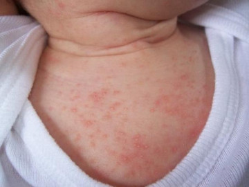 Những mẹo dân gian trị rôm sảy cực nhạy cho bé