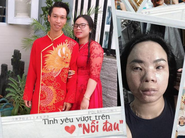 Cô gái xinh đẹp bị tạt axit biến dạng, bạn trai 5 năm nhìn thấy chỉ nói đúng 1 câu