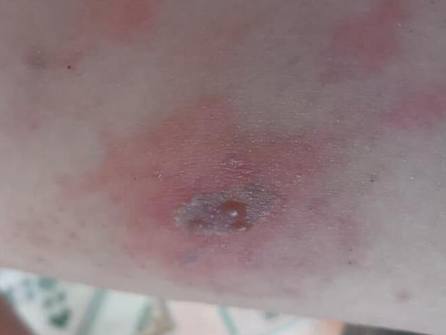 Sau một đêm tỉnh dậy, nhiều người thấy tay sưng đỏ, mưng mủ vì kiến ba khoang tấn công