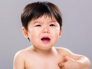 Làm mẹ - Dị ứng ở trẻ là gì? Bác sĩ chỉ rõ dấu hiệu nhận biết