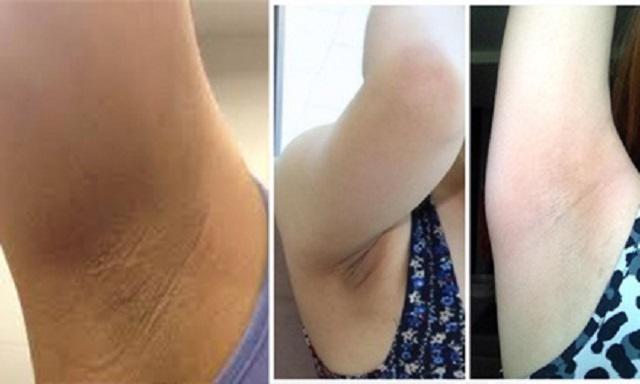 Ngoài “vi-o-long”, da dưới vùng nách đen sạm sần sùi là do bạn chưa biết những điều này - 9