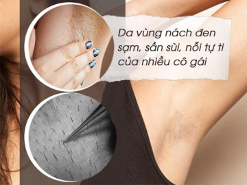 Ngoài “vi-o-long”, da dưới vùng nách đen sạm sần sùi là do bạn chưa biết những điều này