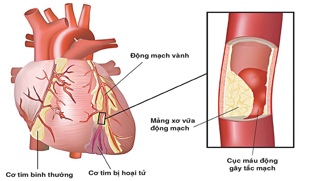 Dấu hiệu bệnh tim thường gặp cần lưu ý - 3