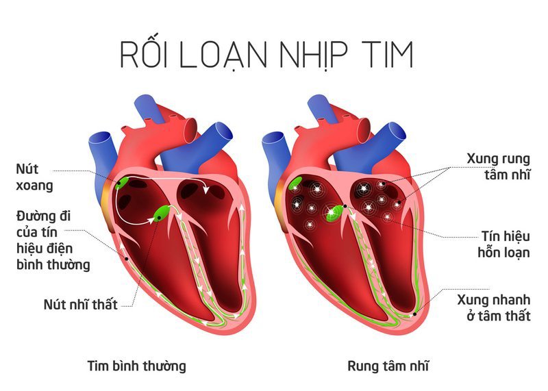 Dấu hiệu bệnh tim thường gặp cần lưu ý - 4